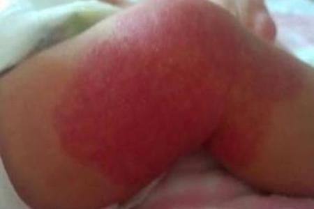 红色胎记算命看危害