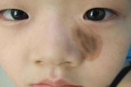 胎记算命介绍