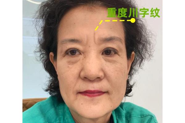 川字纹几种类型，一定要了解清楚：悬针纹、八字纹、双雀纹