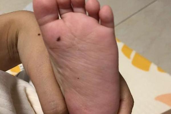 脚底的胎记算命分析