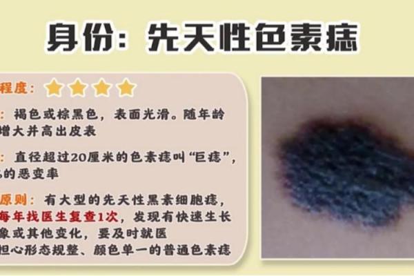 看胎记颜色类型算命