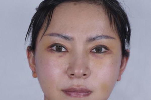 鼻子两侧八字纹图片