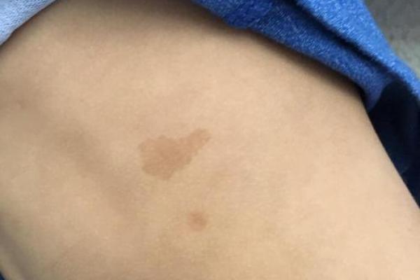风水学上胎记中的有说明什么