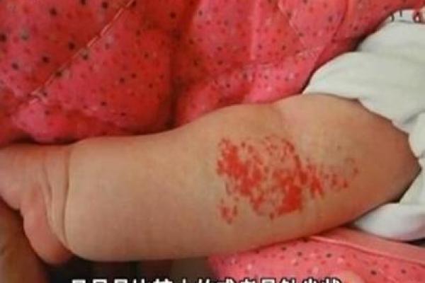 红色的胎记如何看相算命-