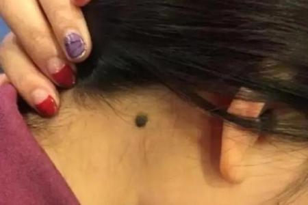 风水上女生脖子后面有痣代表什么啊